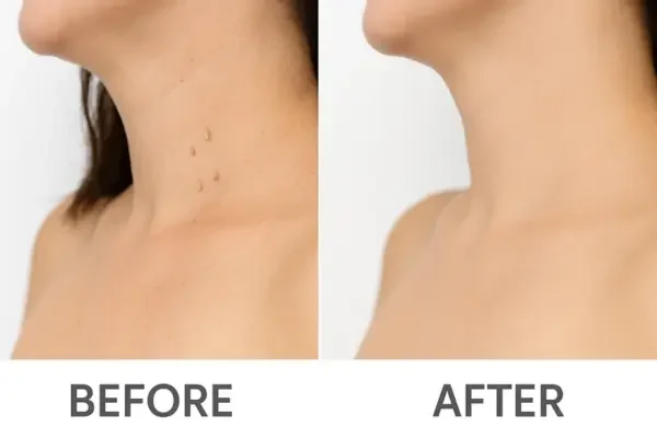 Before-and-After Skin Tag Removal Collage Before-and-after comparison showing the removal of skin tags on a neck: left with visible tags, right with ReviTag Skin Tag Removal.